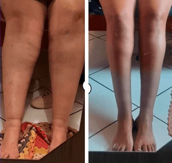 lipedema-antes-e-depois12.jpg